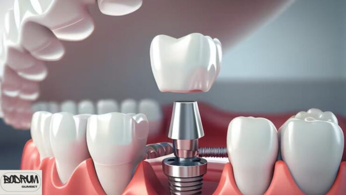 Dental Implants Turkey Dental Implants Turkey